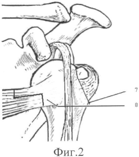 Способ оперативного лечения застарелого переднего вывиха плеча (патент 2332950)