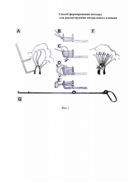Способ формирования неохорд для реконструкции митрального клапана (патент 2629613)