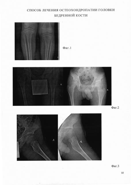 Способ лечения остеохондропатии головки бедренной кости (патент 2608135)