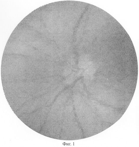 Способ диагностики атрофии зрительного нерва (патент 2282390)