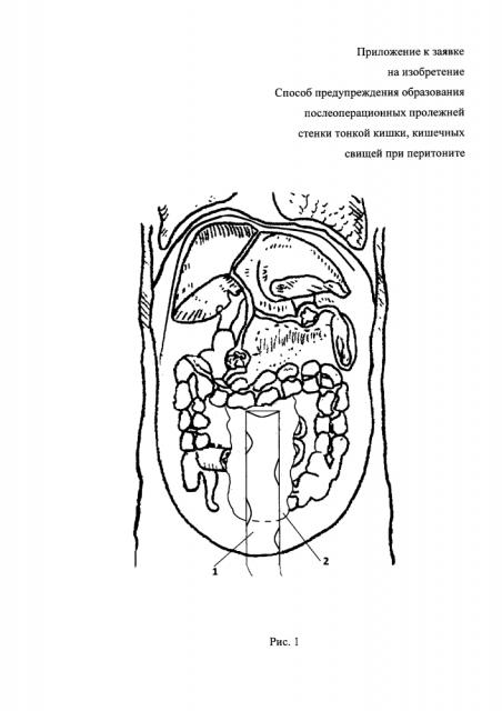 Способ предупреждения образования послеоперационных пролежней стенки тонкой кишки, кишечных свищей при перитоните (патент 2602315)
