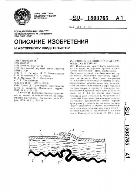 Способ соединения краев ран желудка и кишки (патент 1503765)