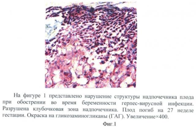 Способ оценки индуцирующего действия герпес-вирусной инфекции на активность формирования дегидроэпиандростеронсульфата и эстрадиола (патент 2452395)