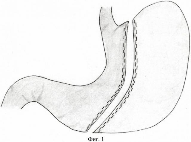 Способ хирургического лечения морбидного ожирения (патент 2428941)
