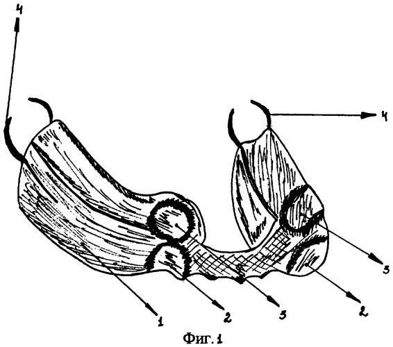 Ортодонтическое устройство (патент 2309703)