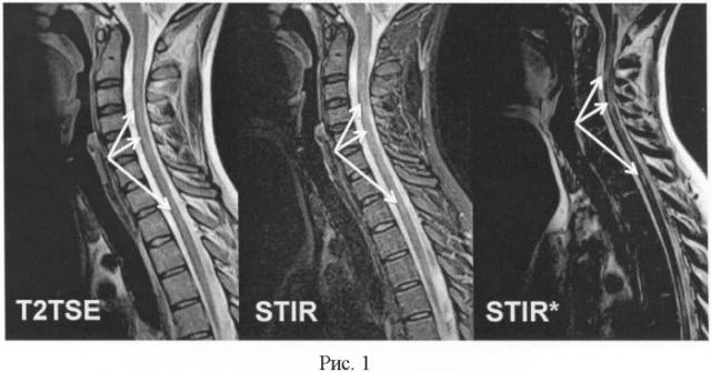 Способ выявления патологических очагов в спинном мозге при рассеянном склерозе (патент 2472433)