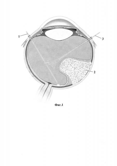 Способ эндовитреального удаления парамакулярной меланомы хориоидеи грибовидной формы (варианты) (патент 2662421)
