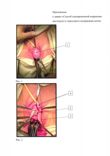 Способ одномоментного лечения цистоцеле и стрессового недержания мочи (патент 2628656)