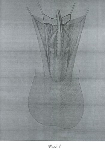 Способ хирургического лечения гипоспадии (патент 2371103)