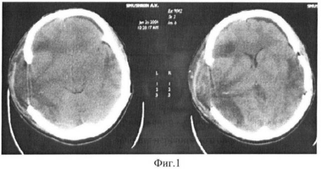 Способ лечения черепно-мозговой травмы (патент 2366466)