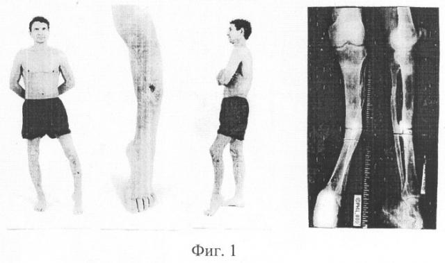 Способ лечения диафизарного псевдоартроза большеберцовой кости в условиях рубцовоизменных мягких тканей (патент 2262317)