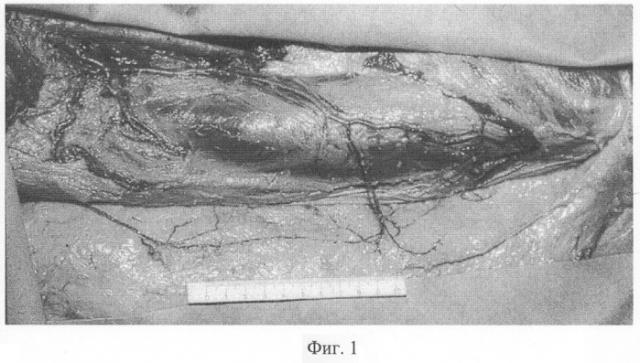 Способ пластики островковым мышечным лоскутом после радикальной хирургической обработки остеомиелитического очага в области вертлужной впадины (патент 2299031)
