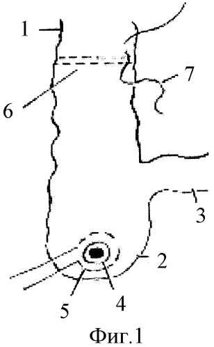 Способ цекостомии при хирургическом лечении болезни гиршпрунга (патент 2341204)