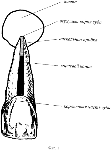 Способ лечения хронического гранулематозного периодонтита (патент 2562101)