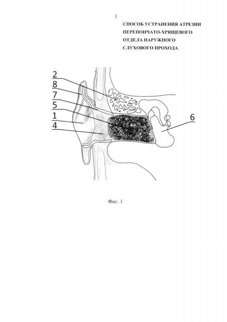 Способ устранения атрезии перепончато-хрящевого отдела наружного слухового прохода (патент 2621948)
