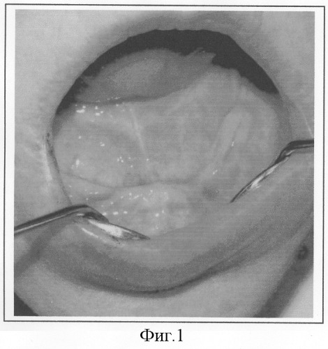 Способ протезирования на беззубой нижней челюсти с повторением рельефа внутренней поверхности базиса старого протеза у пациентов с неблагоприятными клиническими условиями протезного ложа (патент 2293541)