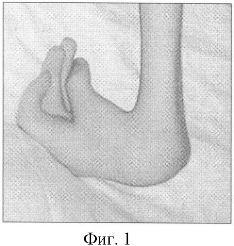 Способ лечения сгибательной контрактуры лучезапястного сустава от 90° и более у больных с артрогрипозом (патент 2373885)