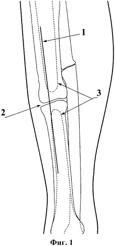 Способ хирургического лечения ложных суставов трубчатых костей конечностей (патент 2349279)