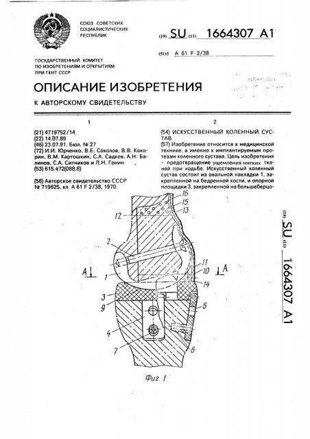 Искусственный коленный сустав (патент 1664307)