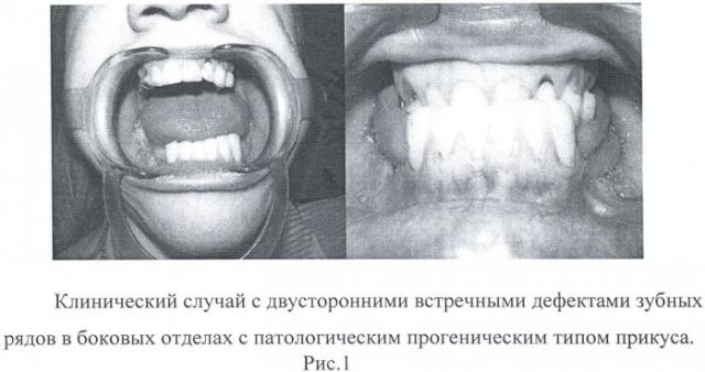 Способ протезирования встречных концевых дефектов зубных рядов (патент 2432117)