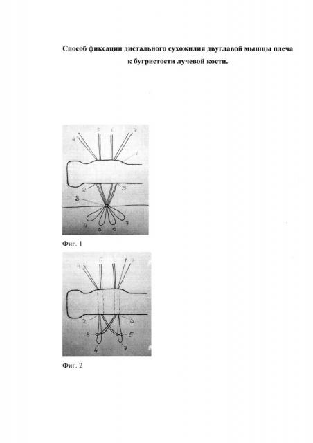 Способ фиксации дистального сухожилия двуглавой мышцы плеча к бугристости лучевой кости (патент 2645616)