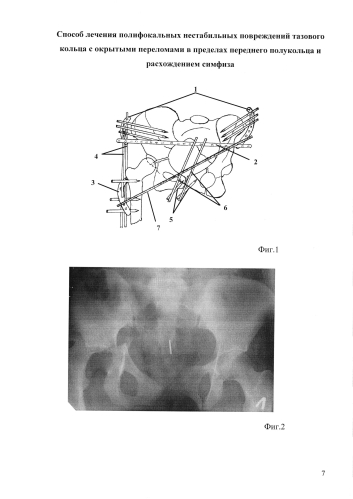 Способ лечения полифокальных нестабильных повреждений тазового кольца с открытыми переломами в пределах переднего полукольца и расхождением симфиза (патент 2578099)