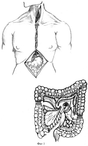 Способ формирования толстокишечно-желудочного анастомоза при пластике пищевода толстой кишкой (патент 2336036)
