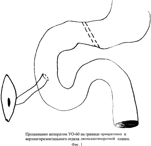 Способ хирургического лечения наружного свища двенадцатиперстной кишки (патент 2352268)