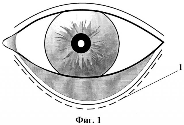 Способ хирургического лечения рубцового выворота нижнего века (патент 2248193)