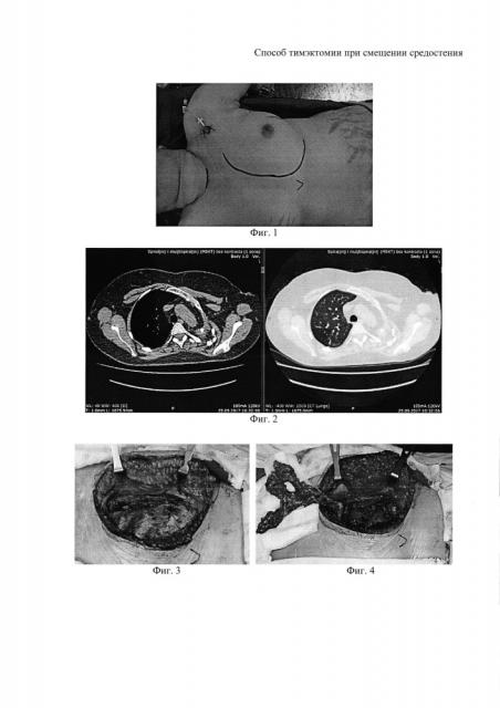Способ тимэктомии при смещении средостения (патент 2663073)