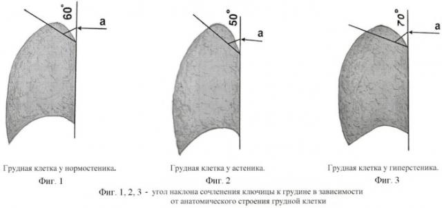 Способ хирургического лечения туберкулеза легких (патент 2417762)