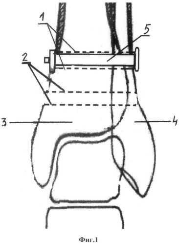 Способ хирургического лечения разрыва связок голеностопного сустава (патент 2534409)