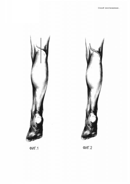 Способ восстановления магистрального артериального кровотока нижних конечностей (патент 2601698)