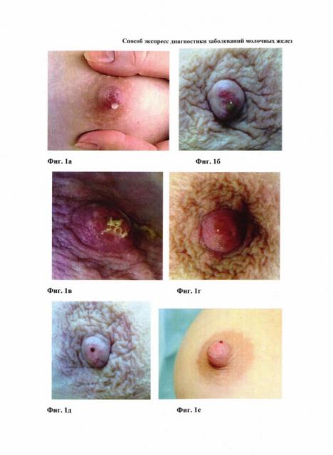 Способ экспресс диагностики заболеваний молочных желез (патент 2620159)