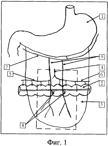 Способ реконструкции языка при обширных дефектах полости рта (патент 2391925)