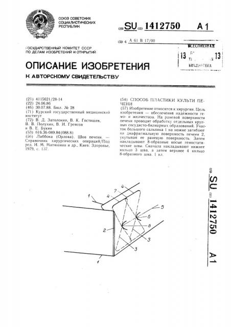 Способ пластики культи печени (патент 1412750)