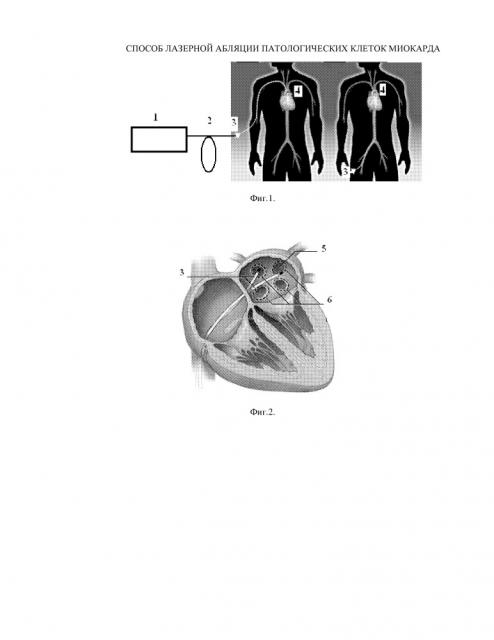 Способ лазерной абляции патологической области сердца (патент 2654764)