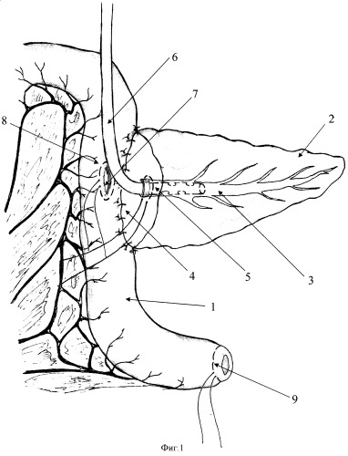 Способ профилактики панкреатита и некроза культи поджелудочной железы после панкреатодуоденальной резекции (патент 2393780)