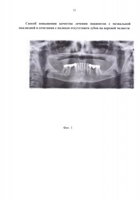 Способ повышения качества лечения пациентов с мезиальной окклюзией в сочетании с полным отсутствием зубов на верхней челюсти (патент 2658159)