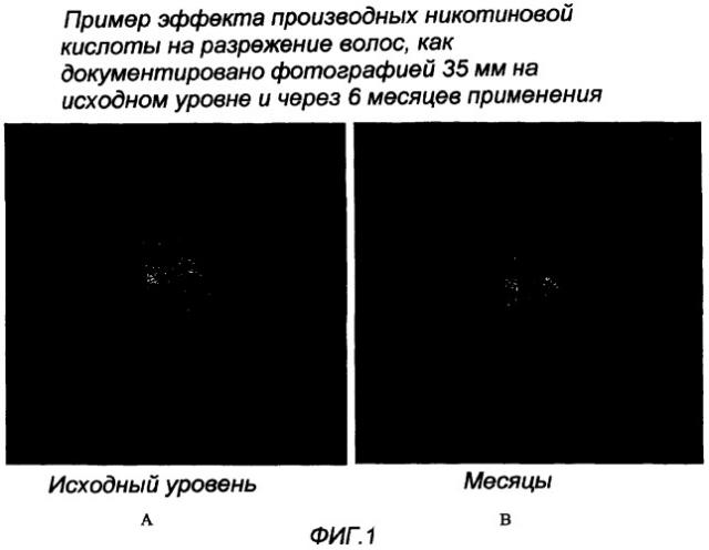 Способ лечения нарушений роста волос, таких как облысение по женскому типу, и применяемые в нем композиции (патент 2381786)