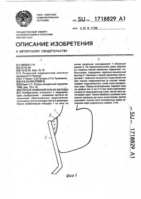 Способ ушивания культи желудка (патент 1718829)