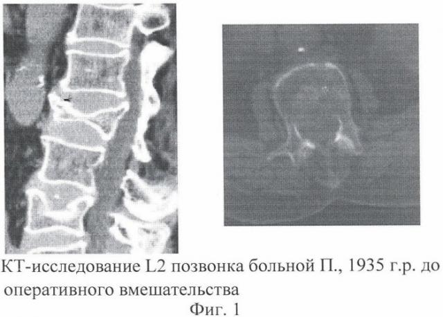 Способ перкутанной вертебропластики при крупнооскольчатых двухфрагментарных переломах тела позвонка (патент 2432910)