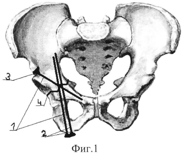 Способ хирургического лечения переломов вертлужной впадины (патент 2547803)