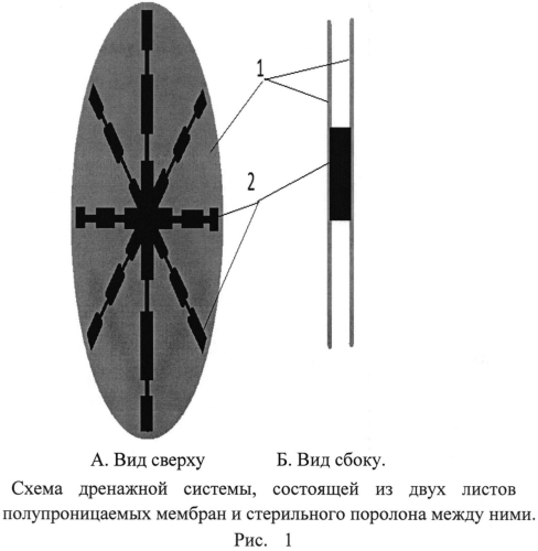 Способ создания активной лапаростомии (патент 2567666)