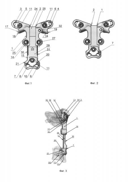Устройство для передней стабилизации шейных позвонков атланто-субаксиального уровня (патент 2652741)