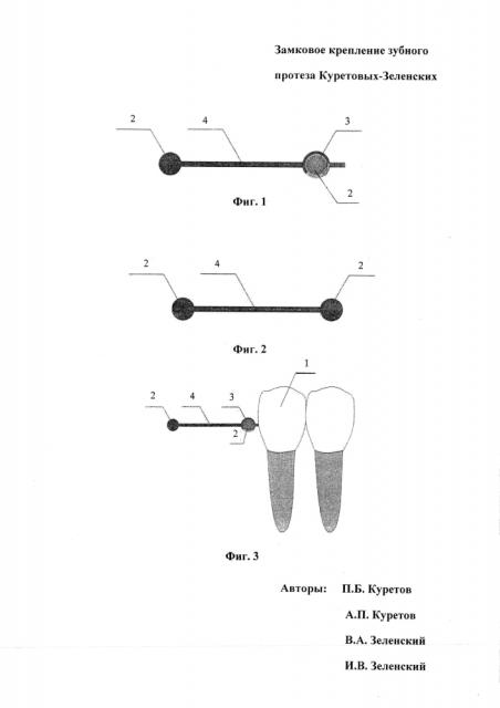 Замковое крепление зубного протеза куретовых-зеленских (патент 2595007)