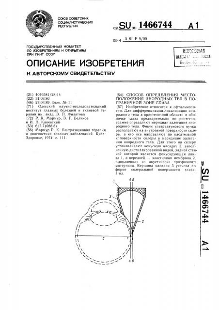 Способ определения местоположения инородных тел в пограничной зоне глаза (патент 1466744)