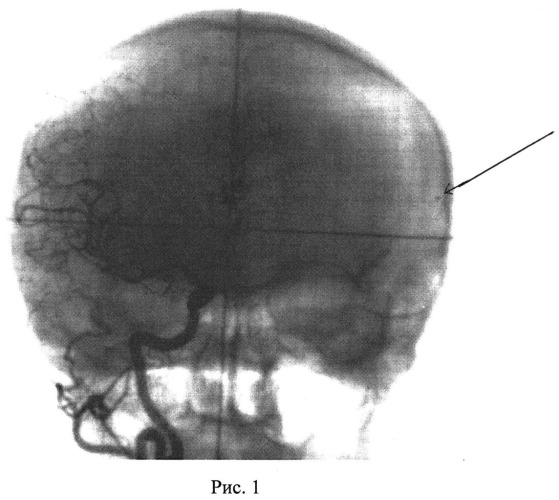 Способ лечения артериовенозных мальформаций головного мозга (патент 2534522)
