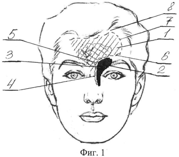 Способ устранения сквозного дефекта носо-лобно-орбитальной области (патент 2525017)