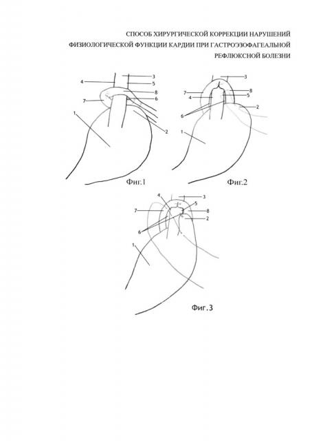 Способ хирургической коррекции нарушений физиологической функции кардии при гастроэзофагеальной рефлюксной болезни (патент 2641064)